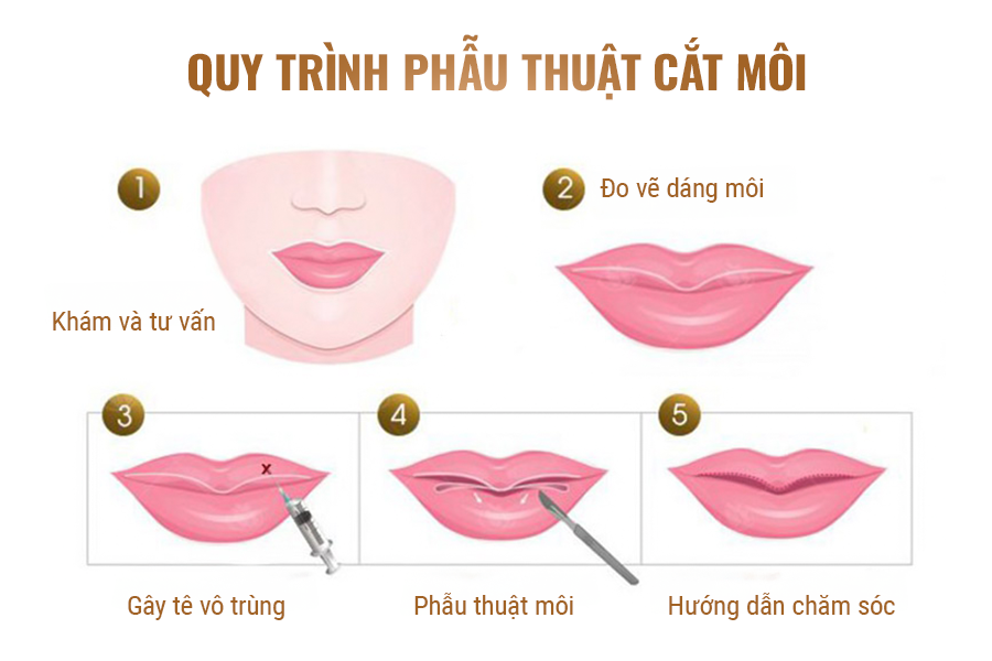 Cắt môi