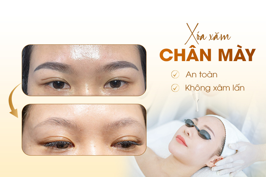 Xóa xăm chân mày