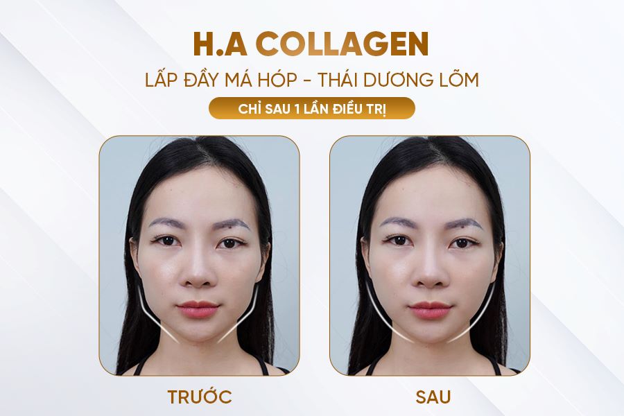 ha collagen