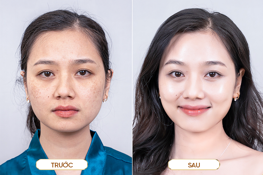 chăm sóc khi cấy tinh chất căng bóng