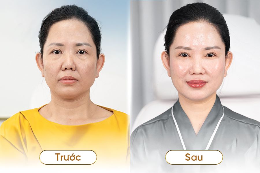 nâng cơ xóa nhăn