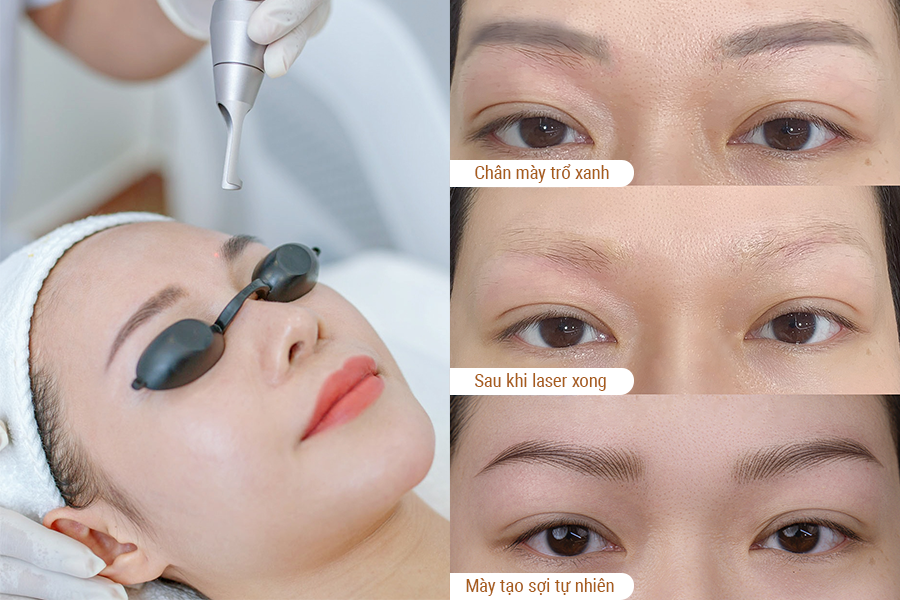 Xóa xăm chân mày có an toàn không? Các phương pháp xóa xăm chân mày hiện đại 2 Xóa xăm chân mày có an toàn không